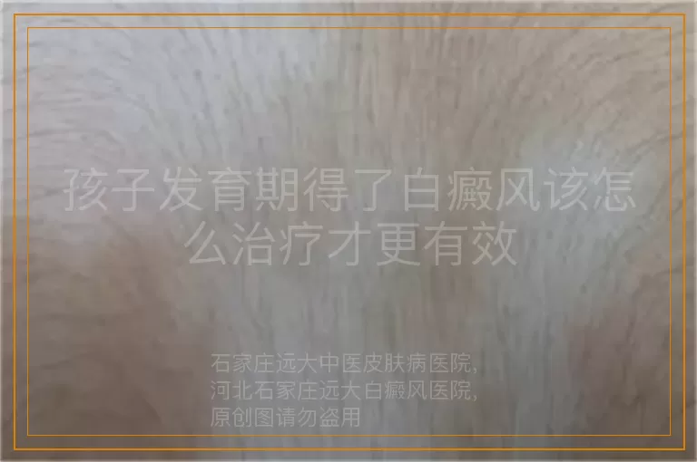 孩子发育期得了白癜风该怎么治疗才更有效