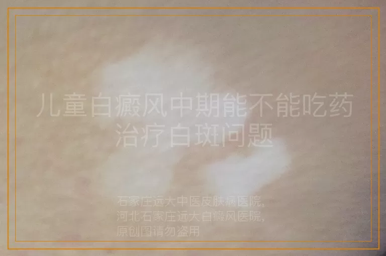 儿童白癜风中期能不能吃药治疗白斑问题