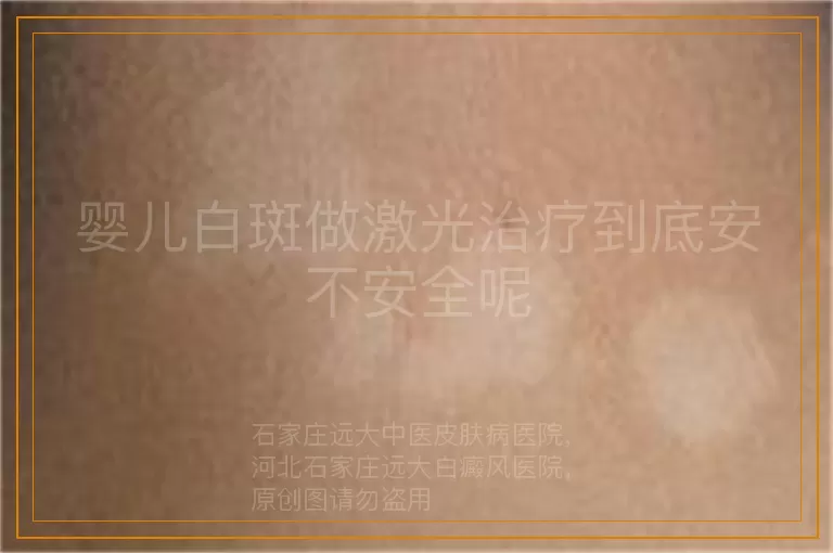 婴儿白斑做激光治疗到底安不安全呢