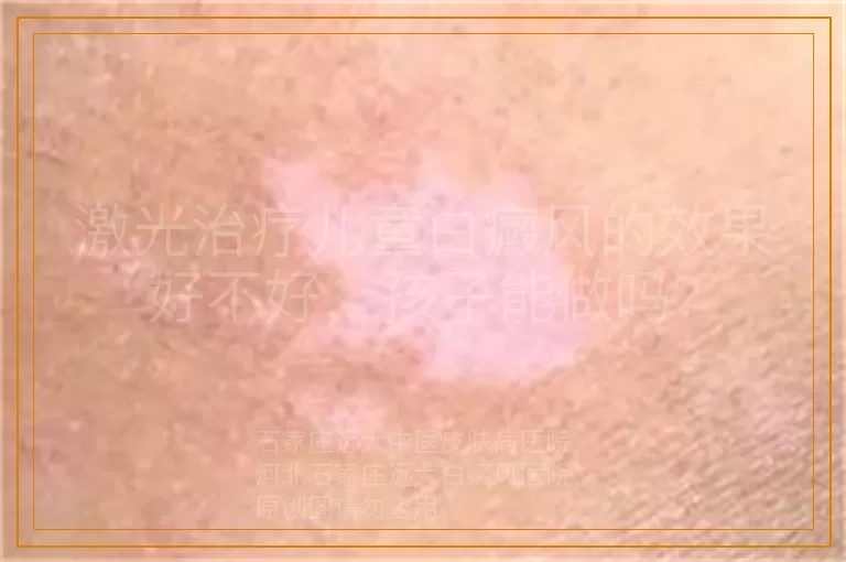 激光治疗儿童白癜风的效果好不好，孩子能做吗？