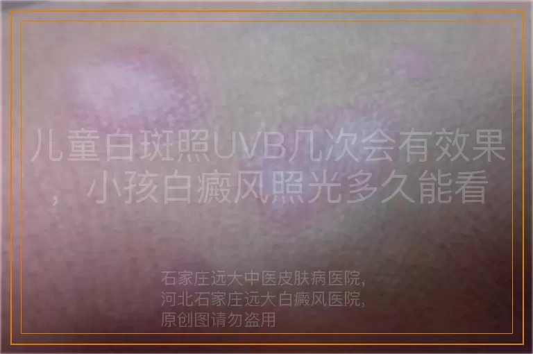 儿童白斑照UVB几次会有效果，小孩白癜风照光多久能看到变化，儿童白癜风照UVB光治疗后几次显效