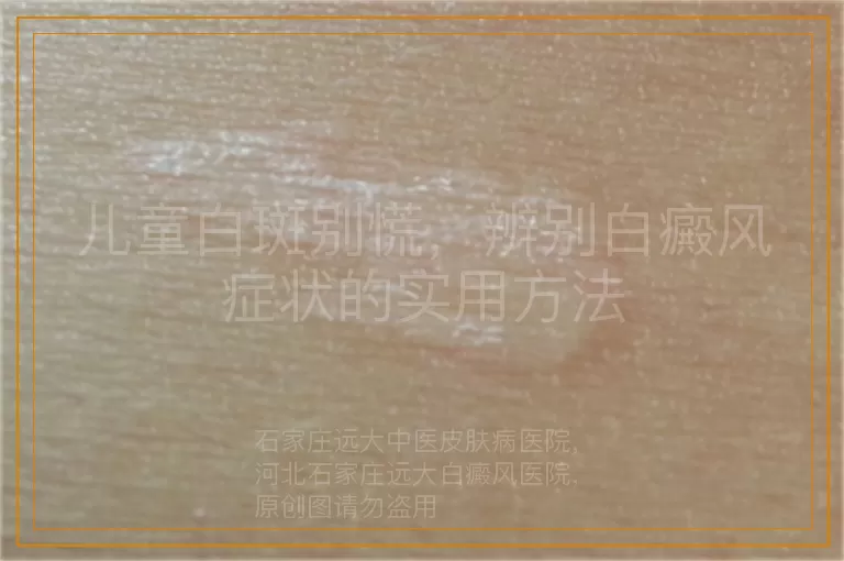 儿童白斑别慌，辨别白癜风症状的实用方法