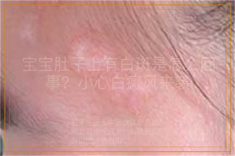 宝宝肚子上有白斑是怎么回事？小心白癜风来袭