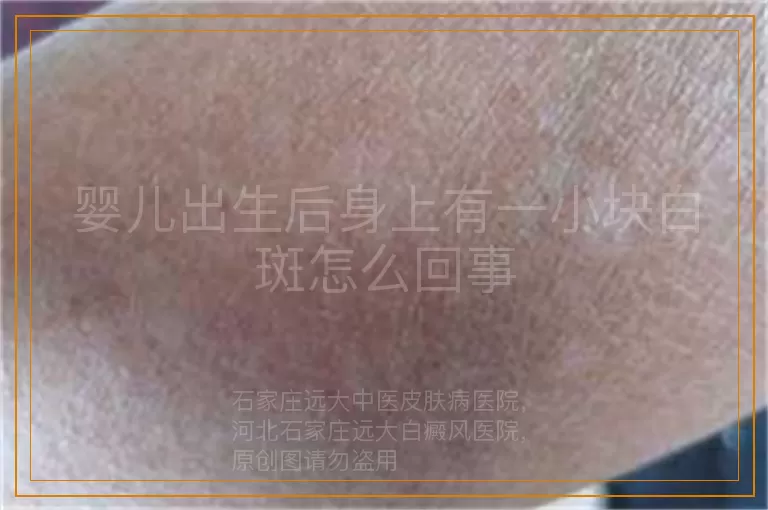 婴儿出生后身上有一小块白斑怎么回事