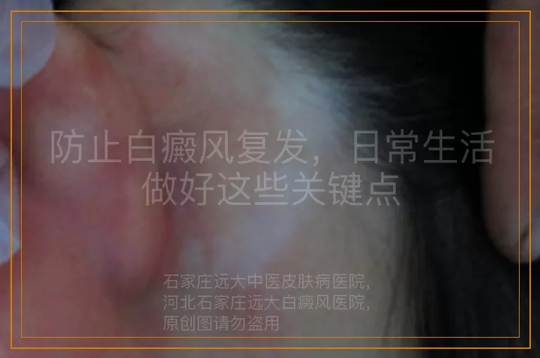 防止白癜风复发，日常生活做好这些关键点