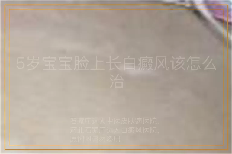 5岁宝宝脸上长白癜风该怎么治