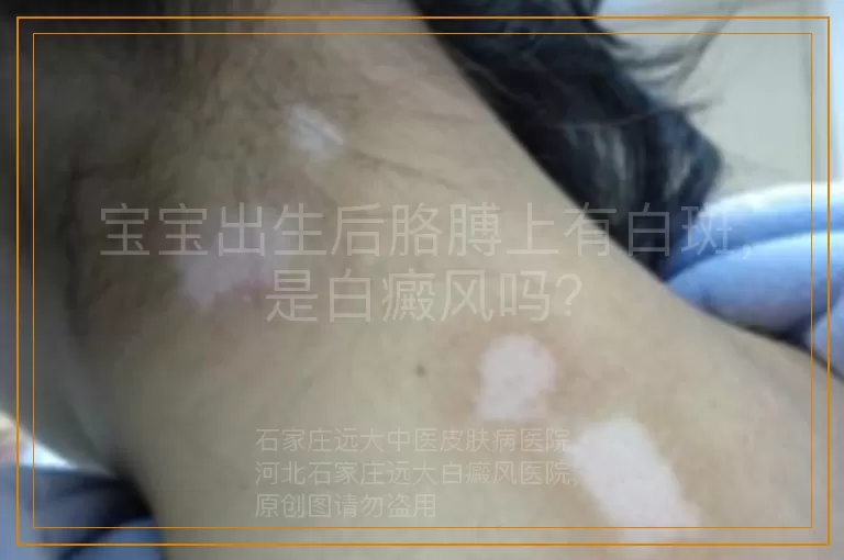 宝宝出生后胳膊上有白斑，是白癜风吗？