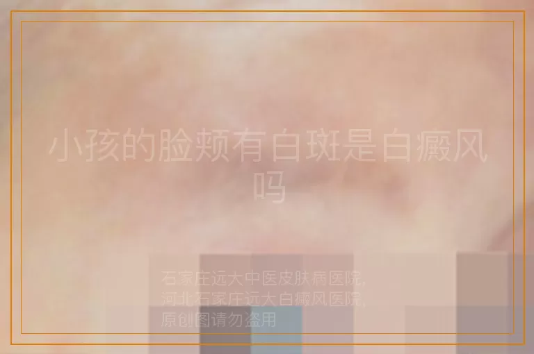 小孩的脸颊有白斑是白癜风吗