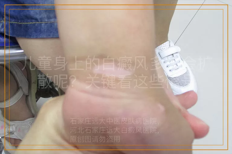 儿童身上的白癜风多久会扩散呢？关键看这些信号