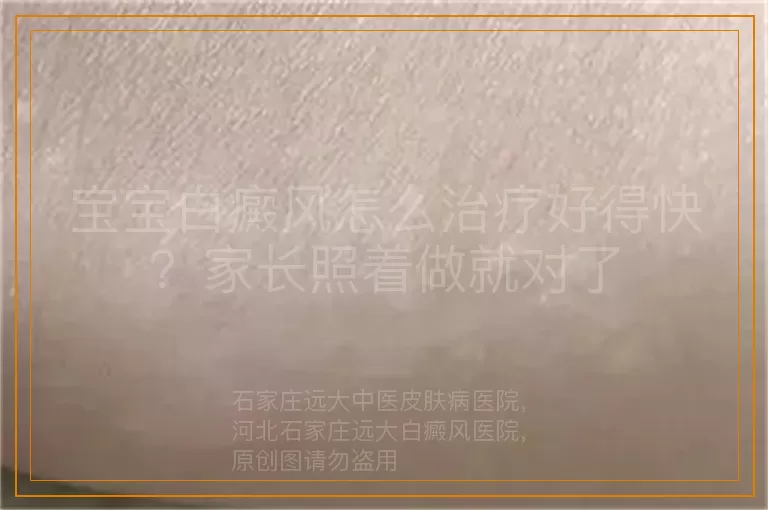 宝宝白癜风怎么治疗好得快？家长照着做就对了