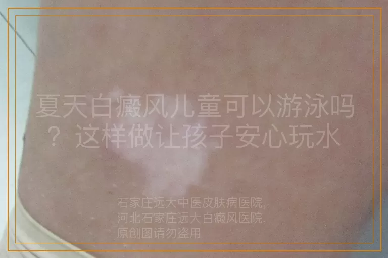 夏天白癜风儿童可以游泳吗？这样做让孩子安心玩水