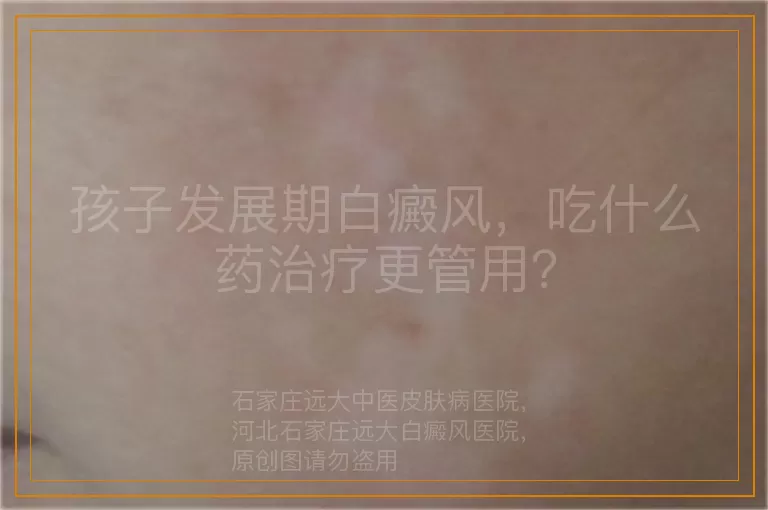 孩子发展期白癜风，吃什么药治疗更管用？