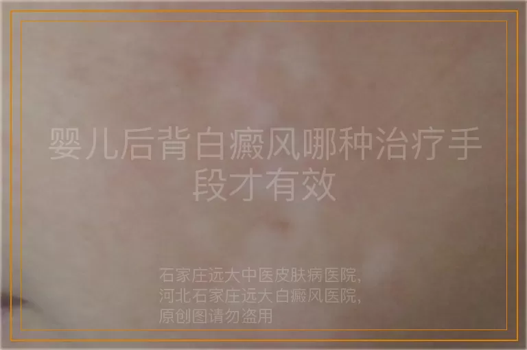婴儿后背白癜风哪种治疗手段才有效