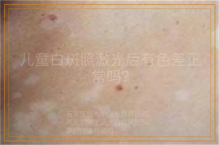 儿童白斑照激光后有色差正常吗？