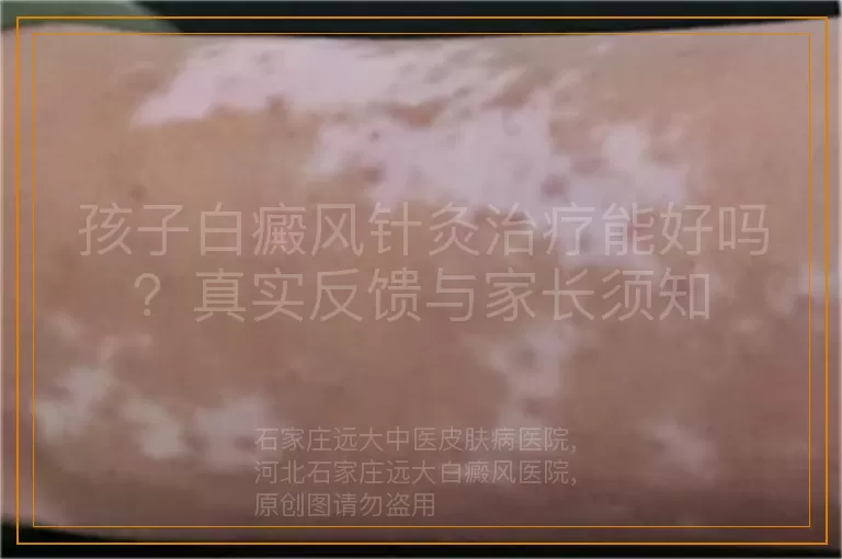 孩子白癜风针灸治疗能好吗？真实反馈与家长须知