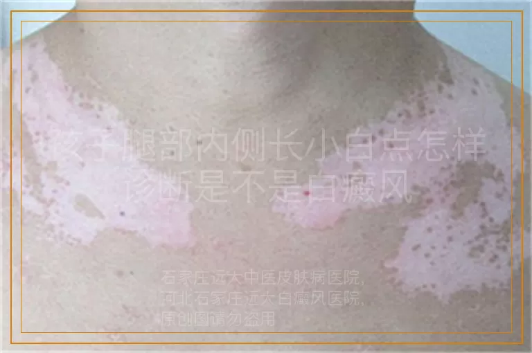 孩子腿部内侧长小白点怎样诊断是不是白癜风