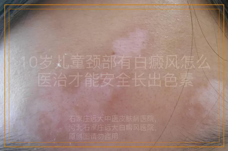 10岁儿童颈部有白癜风怎么医治才能安全长出色素