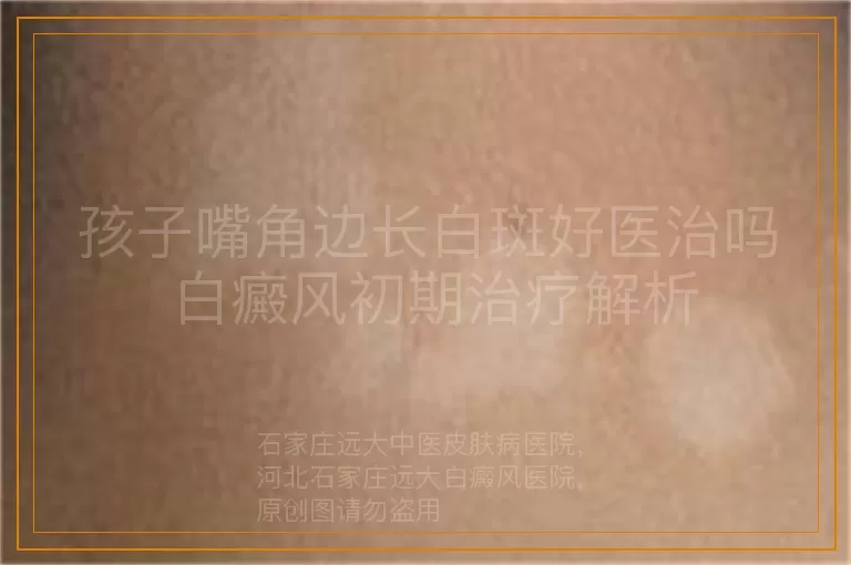 孩子嘴角边长白斑好医治吗 白癜风初期治疗解析