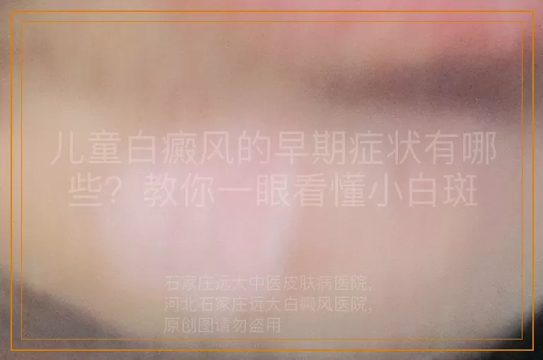 儿童白癜风的早期症状有哪些？教你一眼看懂小白斑