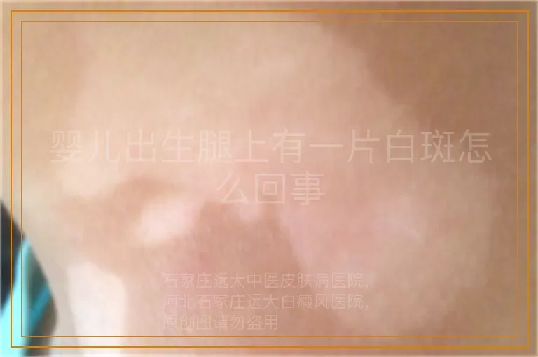 婴儿出生腿上有一片白斑怎么回事