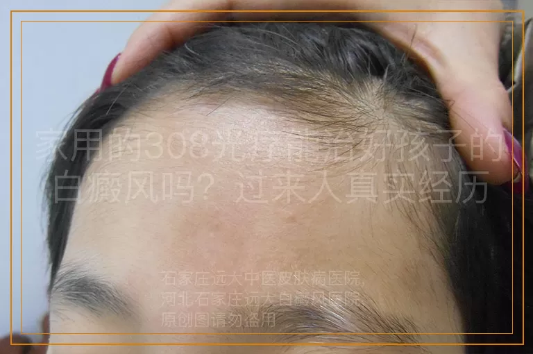 家用的308光疗能治好孩子的白癜风吗？过来人真实经历分享