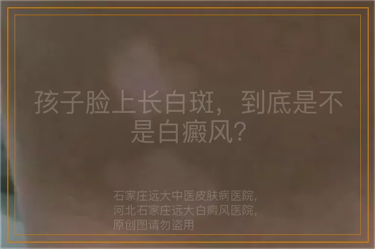 孩子脸上长白斑，到底是不是白癜风？