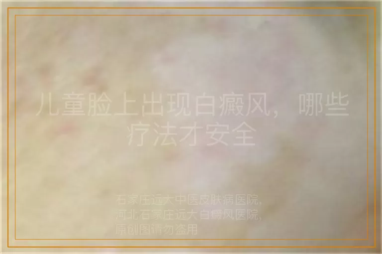 儿童脸上出现白癜风，哪些疗法才安全