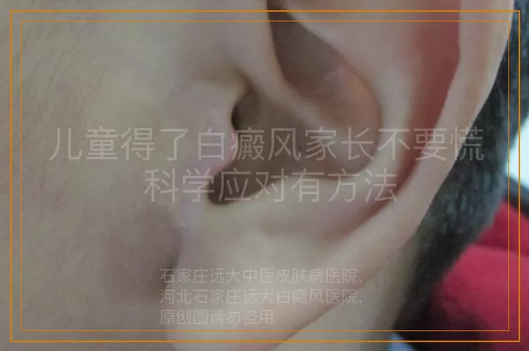 儿童得了白癜风家长不要慌 科学应对有方法
