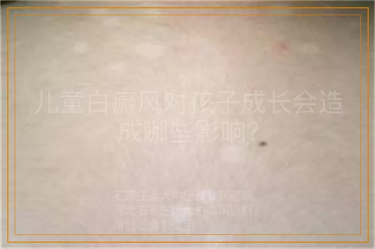 儿童白癜风对孩子成长会造成哪些影响？