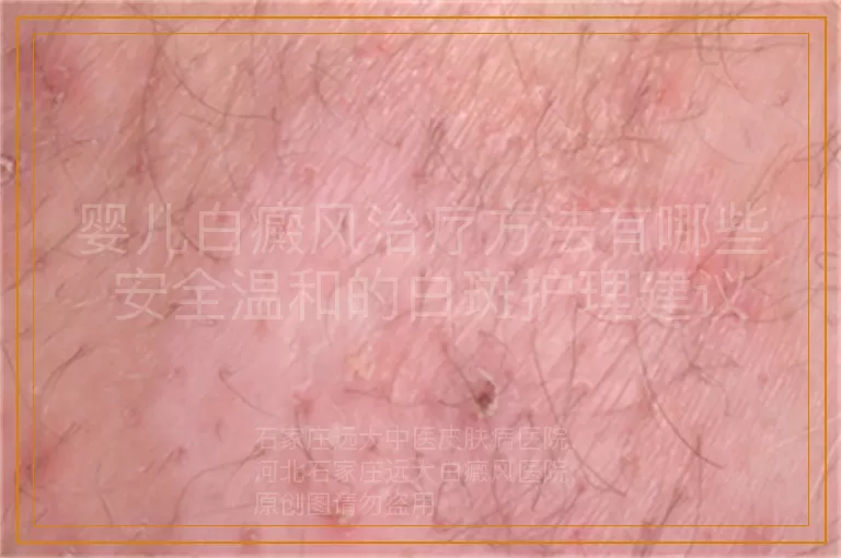 婴儿白癜风治疗方法有哪些 安全温和的白斑护理建议