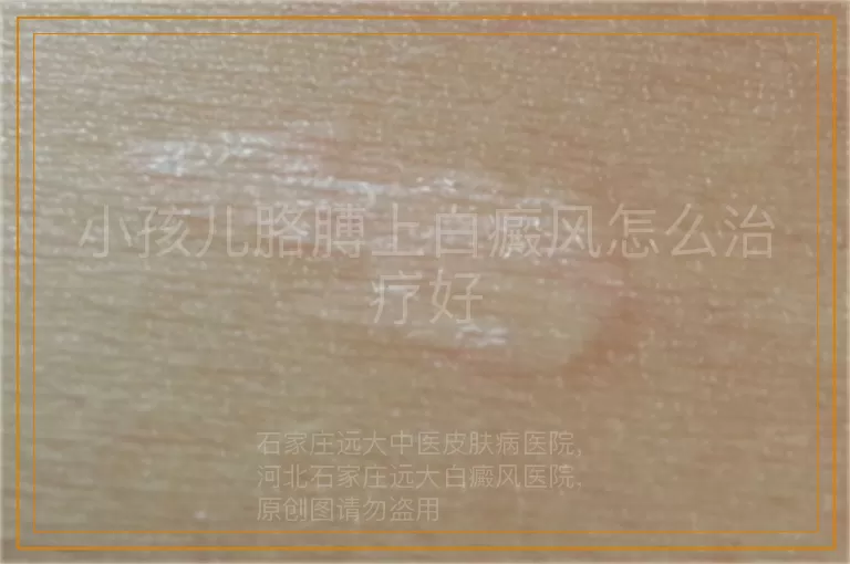 小孩儿胳膊上白癜风怎么治疗好