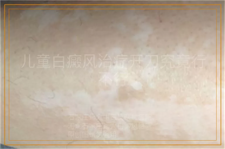 儿童白癜风治疗开刀究竟行不行
