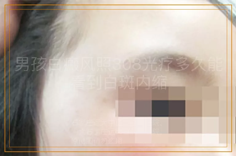 男孩白癜风照308光疗多久能看到白斑内缩