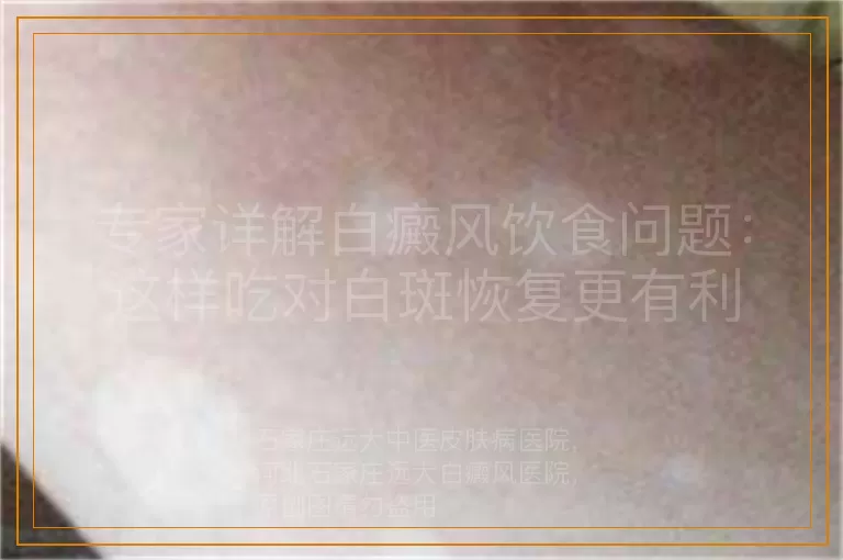专家详解白癜风饮食问题：这样吃对白斑恢复更有利