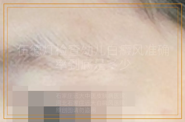 伍德灯检查幼儿白癜风准确率到底是多少