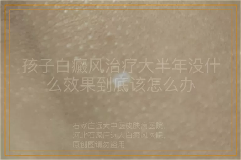 孩子白癜风治疗大半年没什么效果到底该怎么办