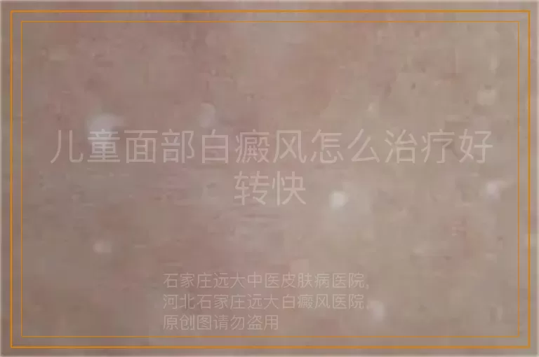 儿童面部白癜风怎么治疗好转快