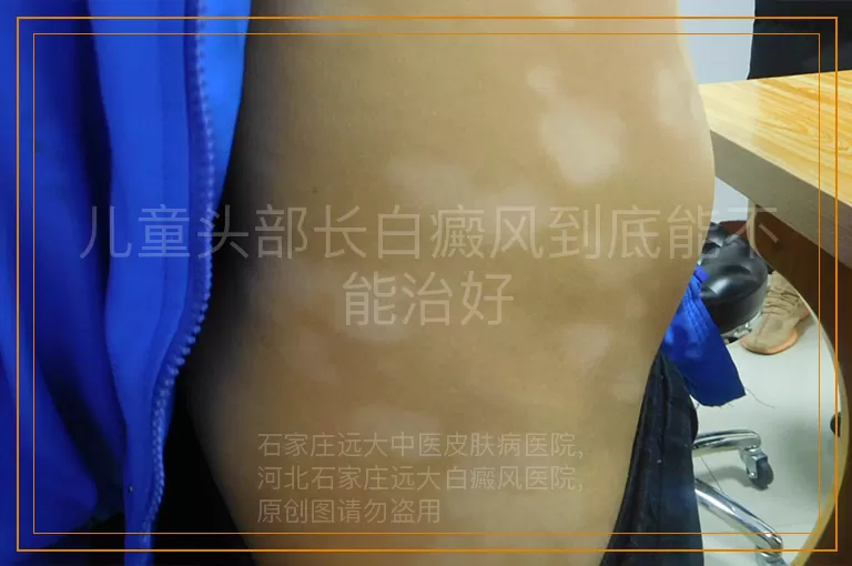儿童头部长白癜风到底能不能治好