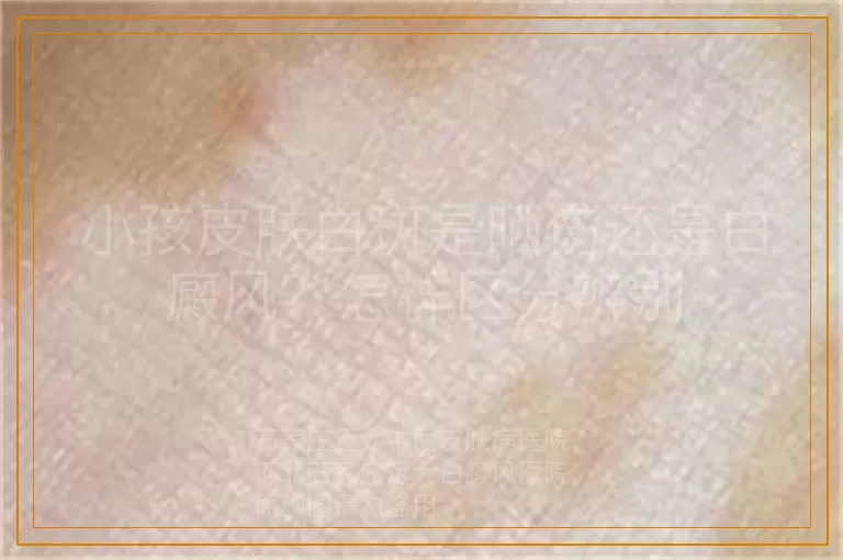 小孩皮肤白斑是晒伤还是白癜风？怎样区分辨别