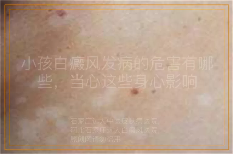 小孩白癜风发病的危害有哪些，当心这些身心影响