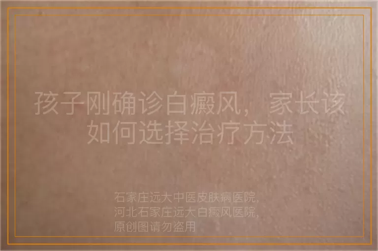 孩子刚确诊白癜风，家长该如何选择治疗方法