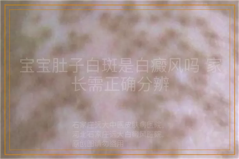 宝宝肚子白斑是白癜风吗 家长需正确分辨