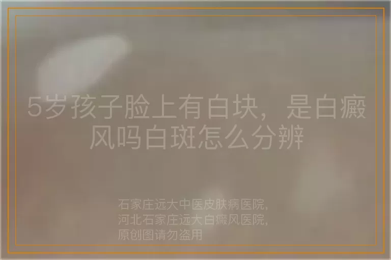 5岁孩子脸上有白块，是白癜风吗白斑怎么分辨