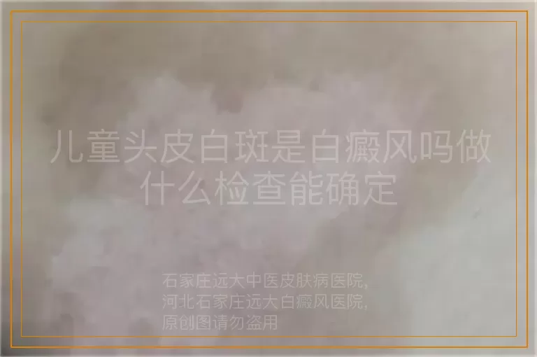儿童头皮白斑是白癜风吗做什么检查能确定