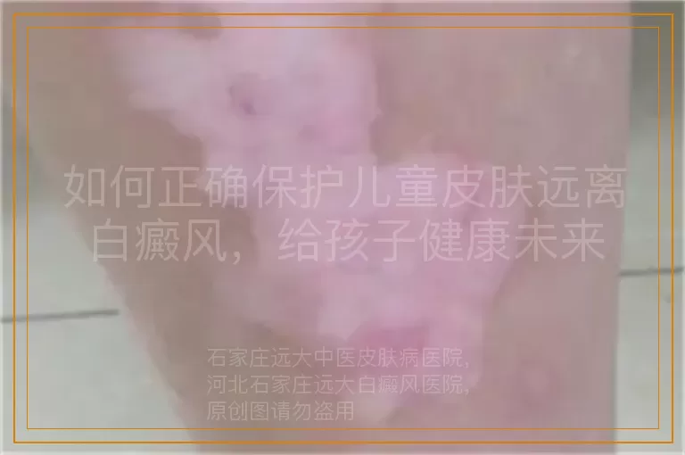 如何正确保护儿童皮肤远离白癜风，给孩子健康未来