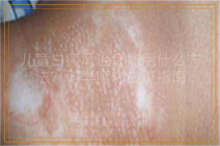 儿童白癜风治疗能用什么方法？科学应对白斑指南