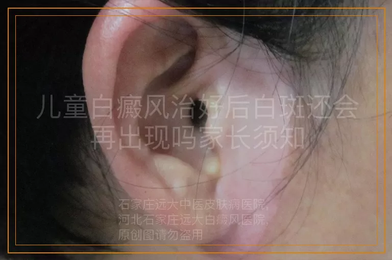 儿童白癜风治好后白斑还会再出现吗家长须知
