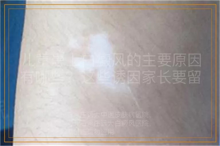 儿童患上白癜风的主要原因有哪些？这些诱因家长要留意