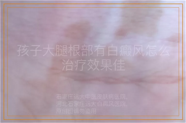 孩子大腿根部有白癜风怎么治疗效果佳