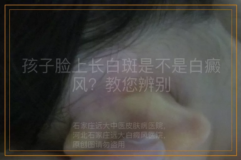 孩子脸上长白斑是不是白癜风？教您辨别